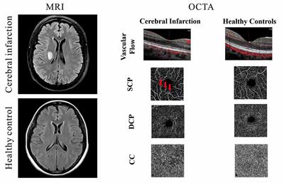 Reduced Superficial Capillary Density in Cerebral Infarction Is Inversely Correlated With the NIHSS Score